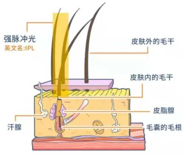 仪采用的是ipl强脉冲光,原理是将光能转化为热能,改变深层毛囊结构