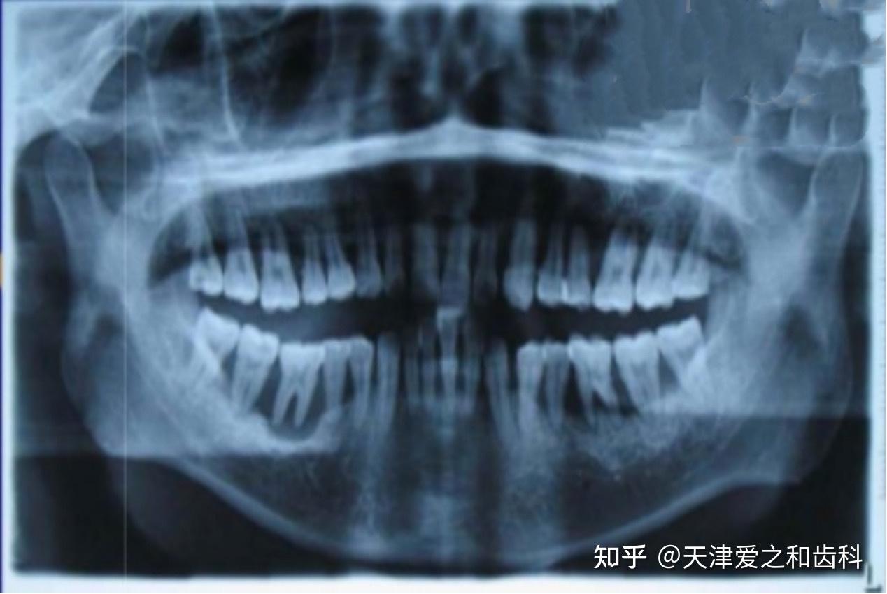 牙周炎之侵襲性牙周炎的恐怖之處