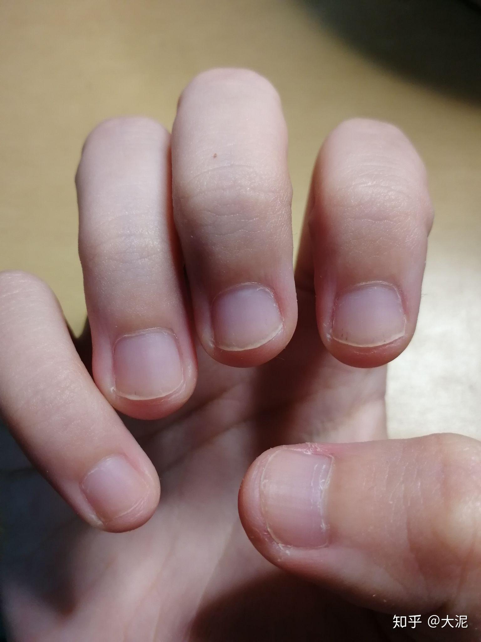 手指甲前端有血丝，一碰还很疼，是怎么回事，过段时间指甲长出来，血丝也跟着长出来了。_百度知道