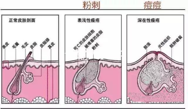 科普｜粉刺和痘痘有什么区别？ - 知乎