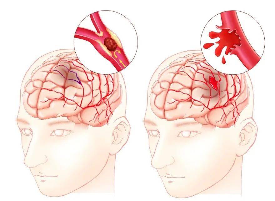 损伤症状为主要临床表现的疾病,主要分为出血性脑中风和缺血性脑中风