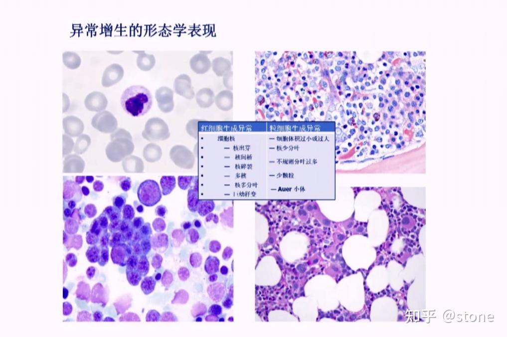 MDS/MPN（骨髓增生异常综合征/骨髓增殖性肿瘤） - 知乎