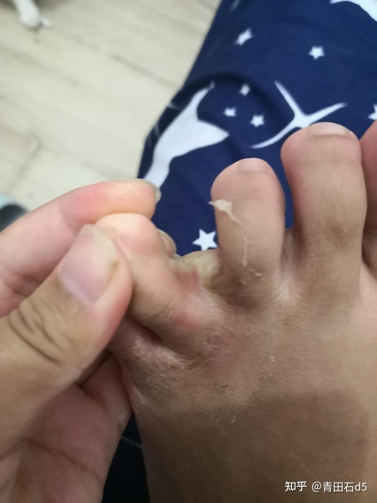 脚上开始破皮,发痒,脚缝也开始溃烂,味道越来越难闻,这才引起了我的