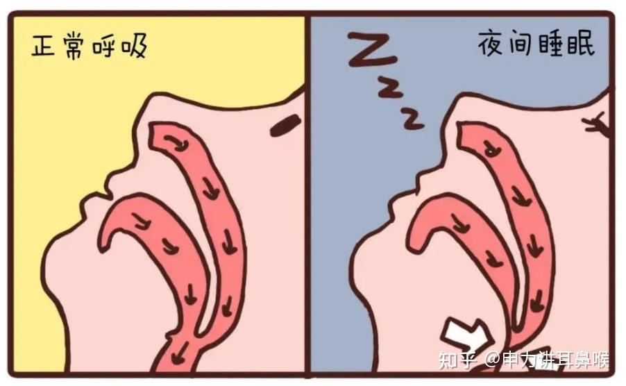 如果不治疗长期打呼噜会怎么样