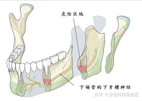 智齿接近神经，到底该不该拔？ - 知乎
