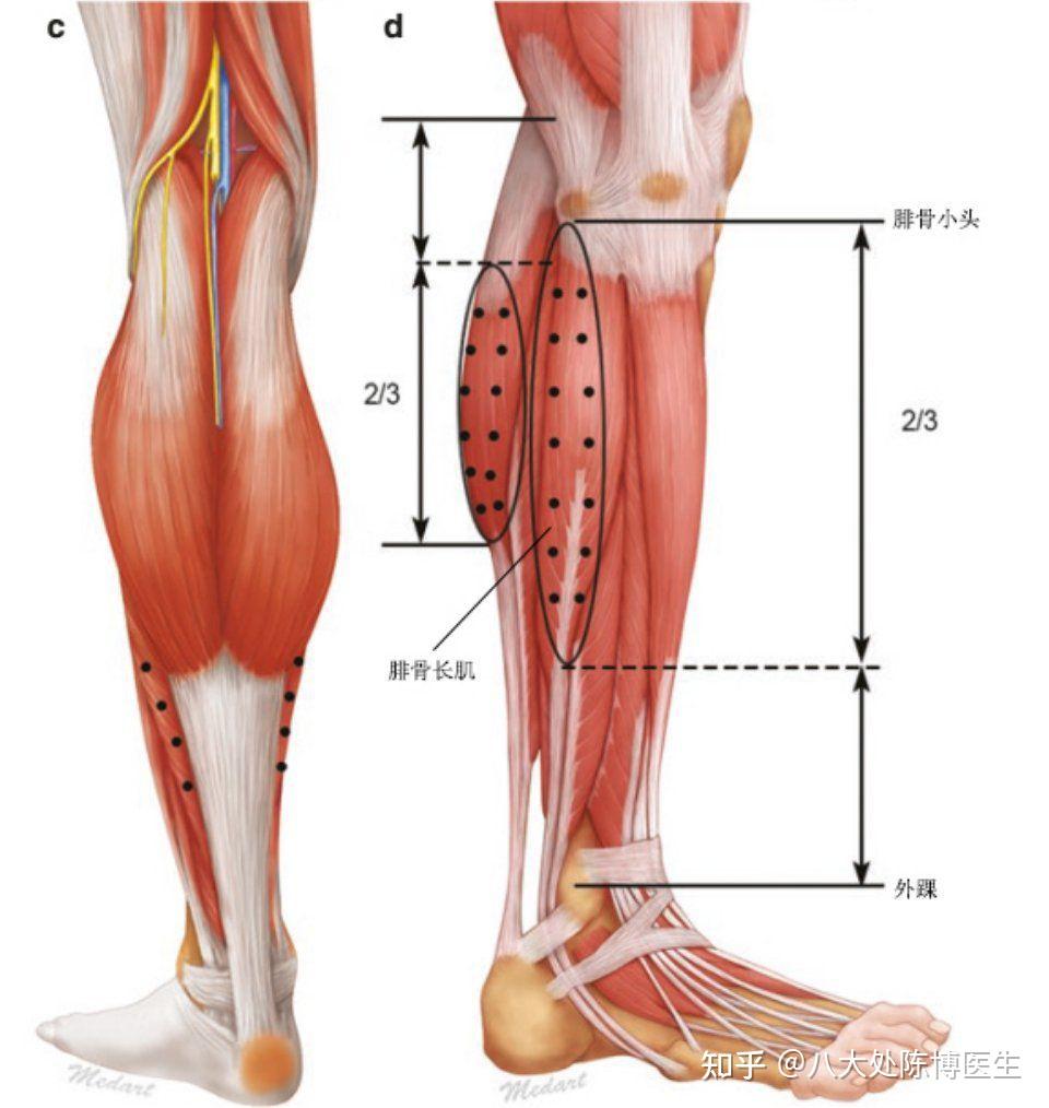 小腿肌肉 示意图图片