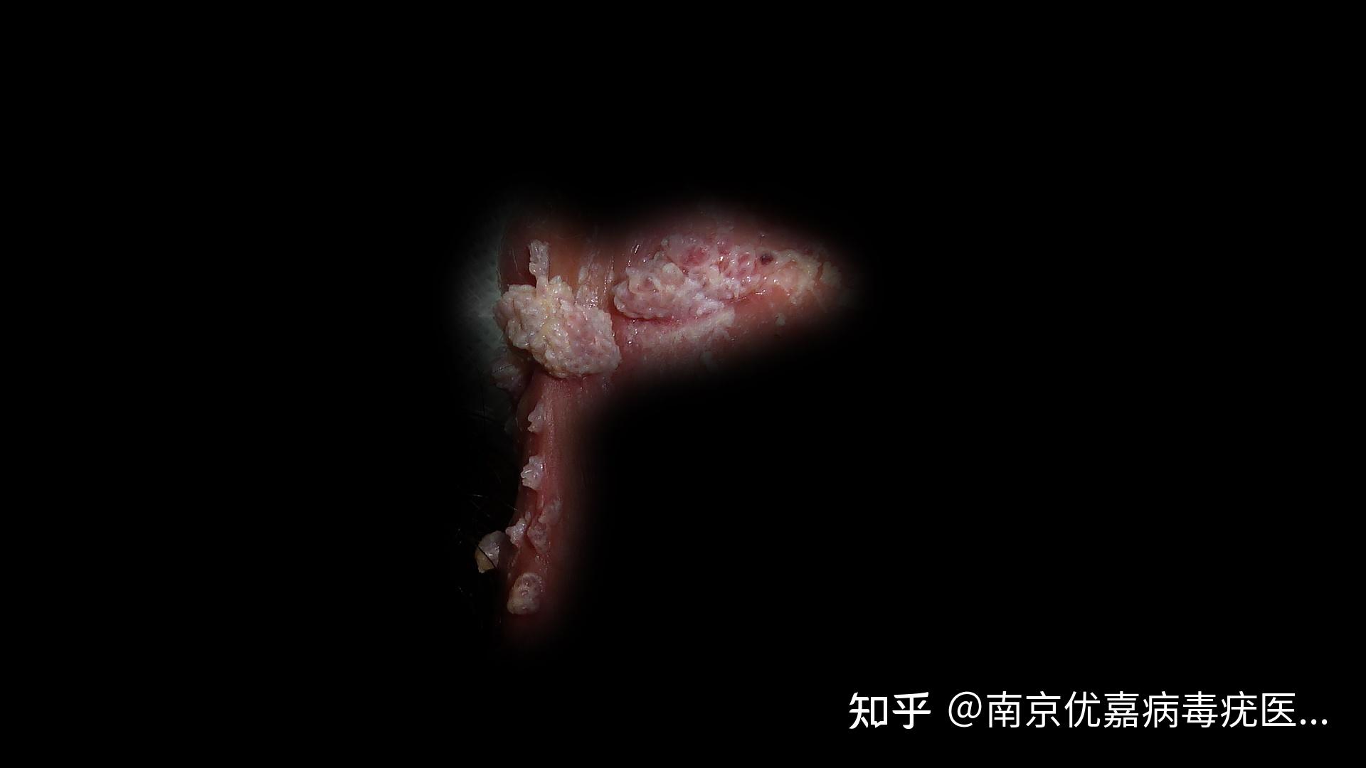 儿童肛周尖锐湿疣 女性会阴尖锐湿疣