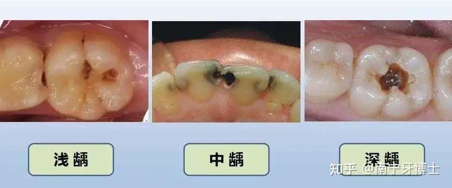 蛀牙不補小洞不補大洞吃苦後期有你好受的