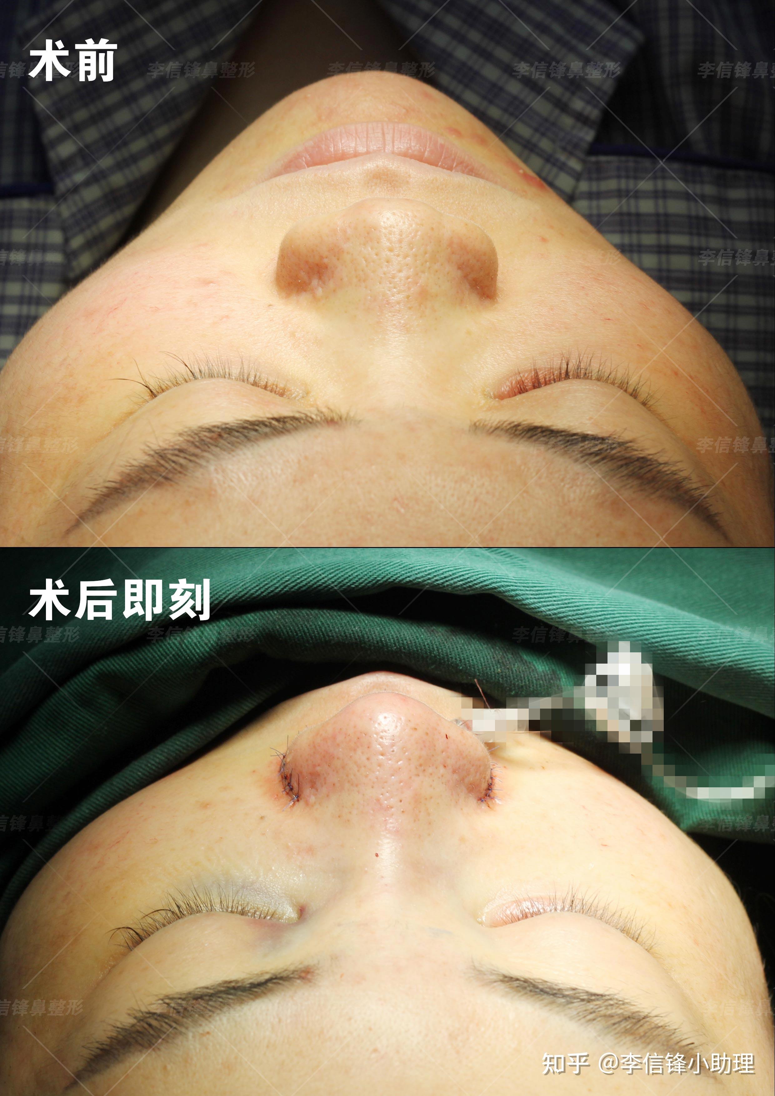 深圳李信锋隆鼻综合整形-蒜头鼻案例分享