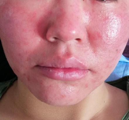 脸动不动爆痘干痒发红是不是激素脸