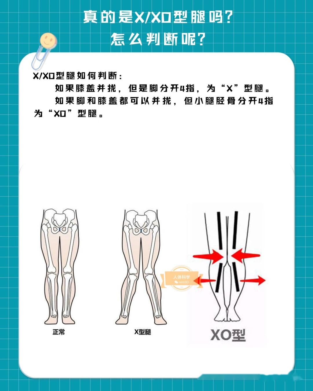 OX型腿，小腿外翻，X型腿，原来练这个部位就可以把腿变直！_哔哩哔哩 (゜-゜)つロ 干杯~-bilibili