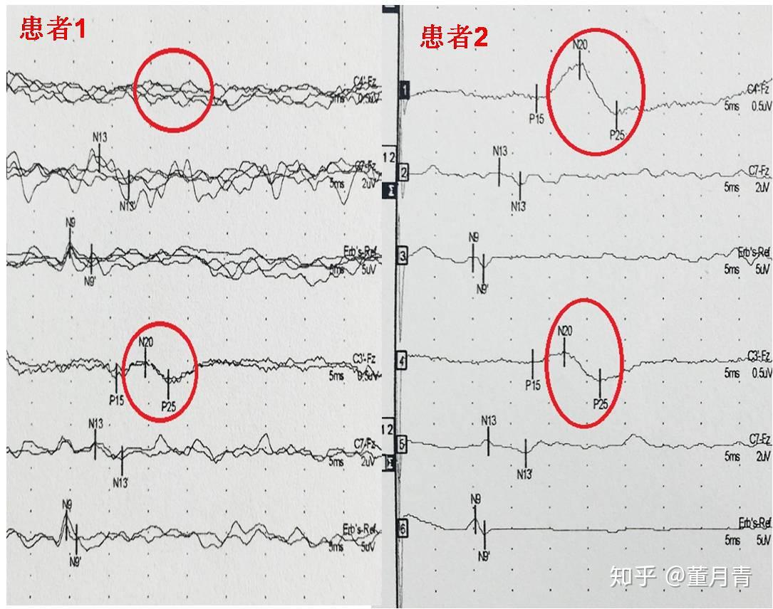 图3:同时存在听觉诱发电位和上肢体感诱发电位的恢复可能性更大.