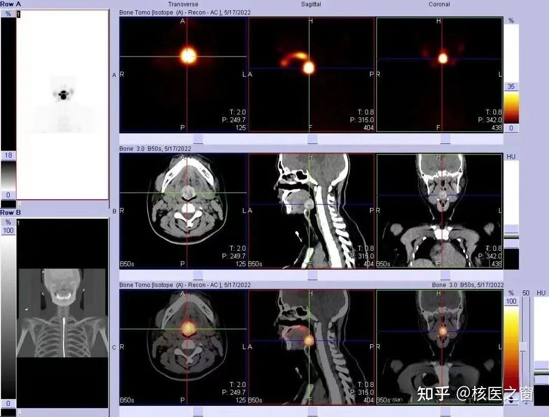 甲状腺生病，核医学来帮忙！ - 知乎