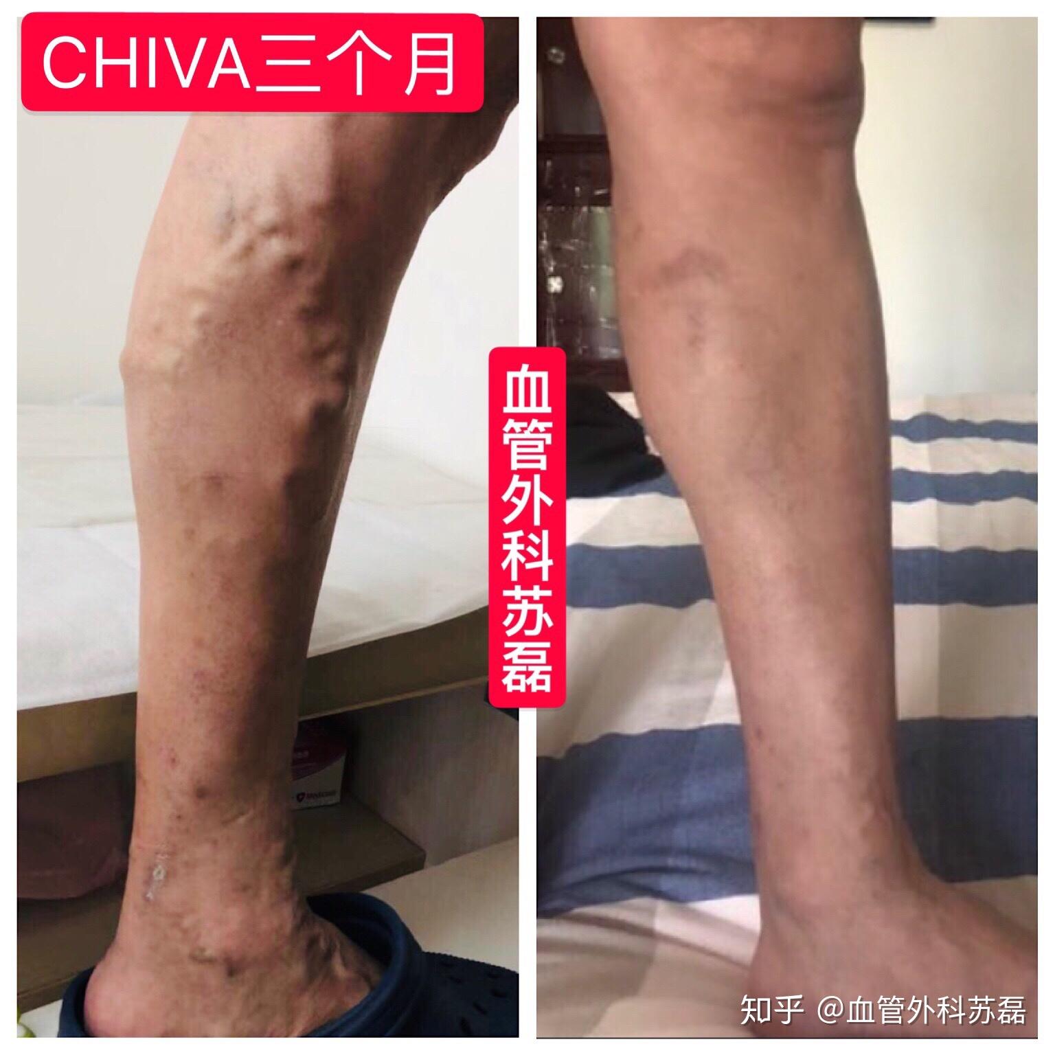 静脉曲张手术治疗效果图
