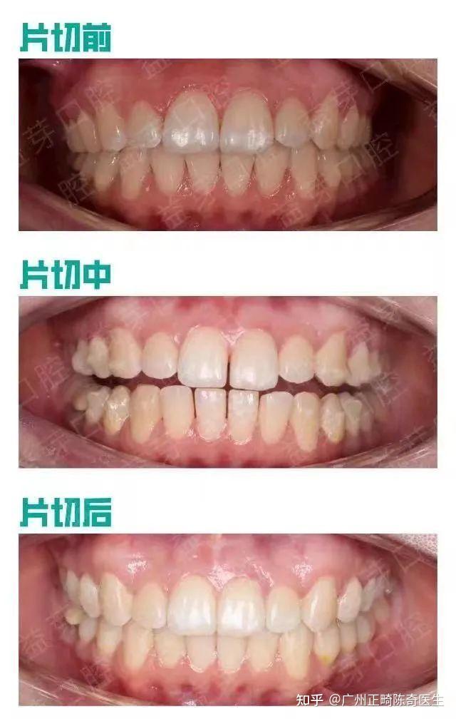 比如牙齿前凸,或者轻微拥挤不够位置的牙齿,如果能够通过片切就排整齐