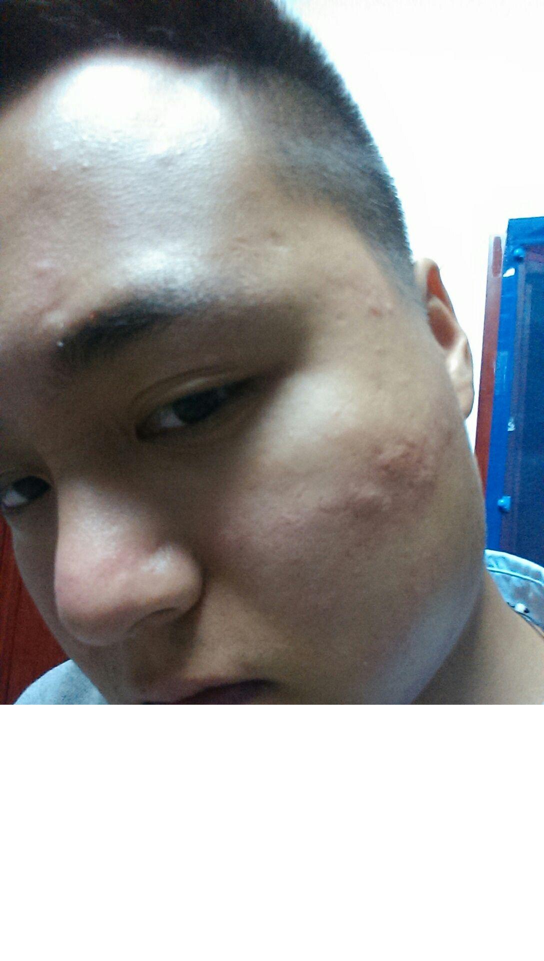 脸上突然会起痘痘,一个多小时自己恢复,? - 皮肤