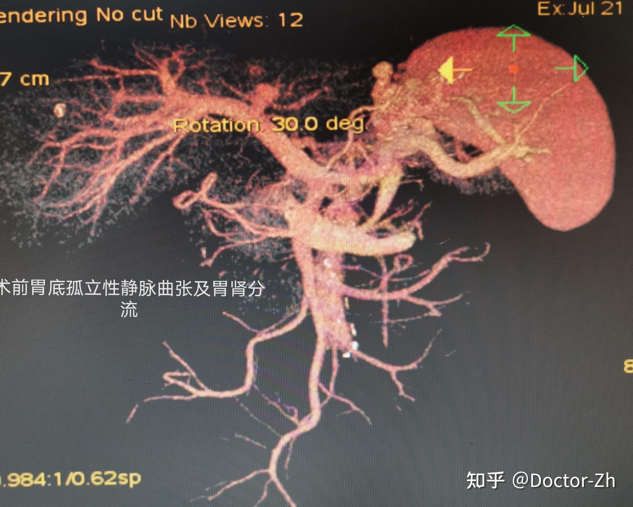 门脉高压性肠病图片