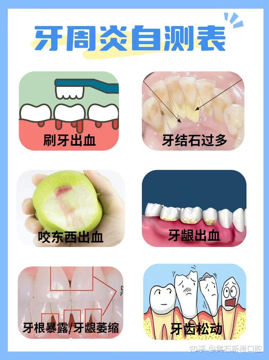 牙周炎如何”自测”?牙周炎患者需要注意什么? - 知乎