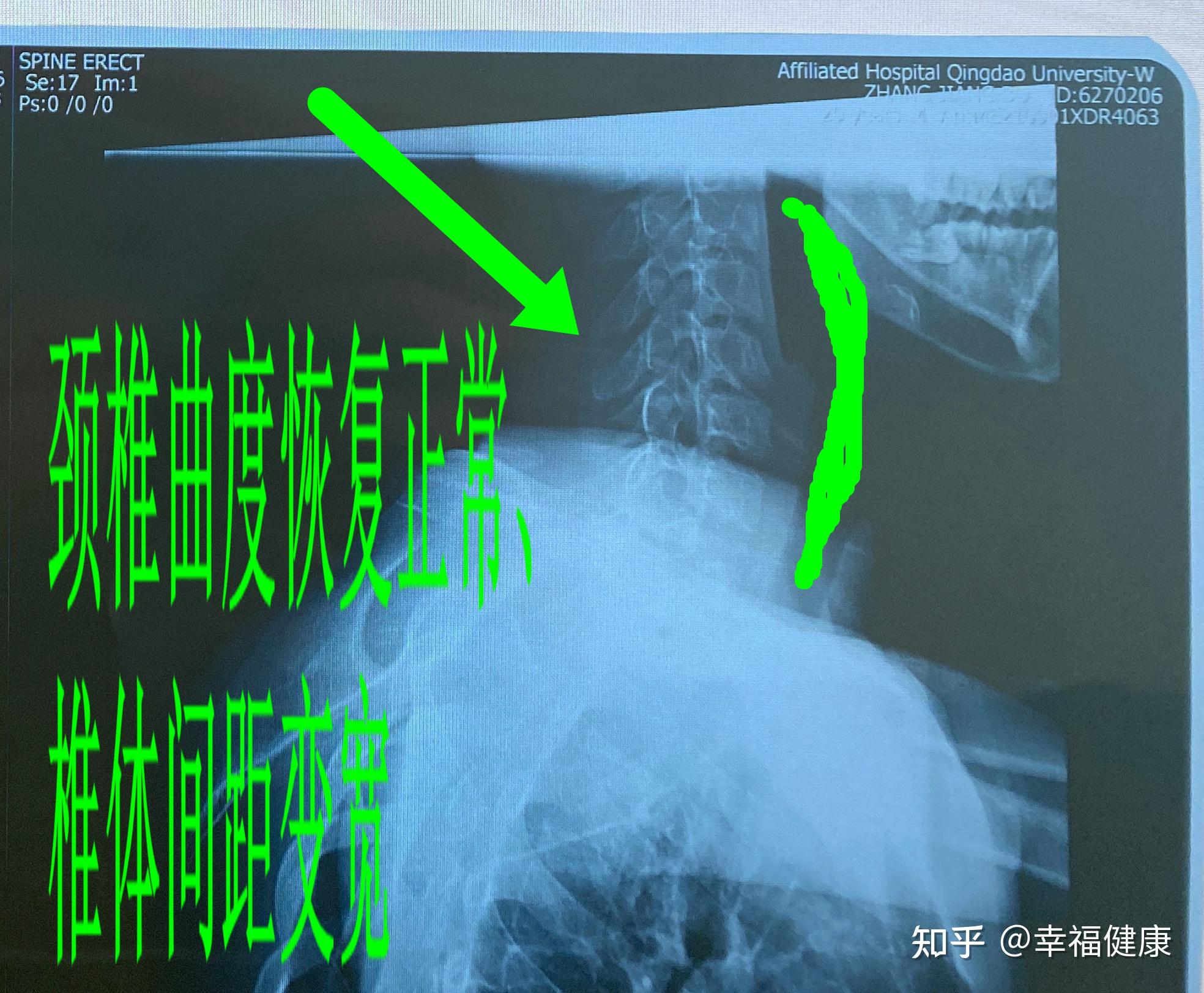 3天康复颈椎病颈椎反弓