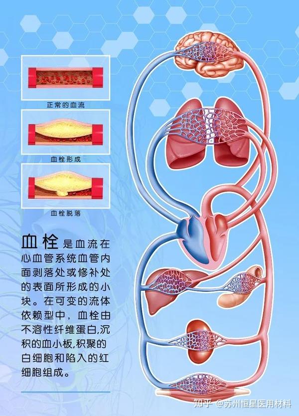 什么是血栓? - 知乎