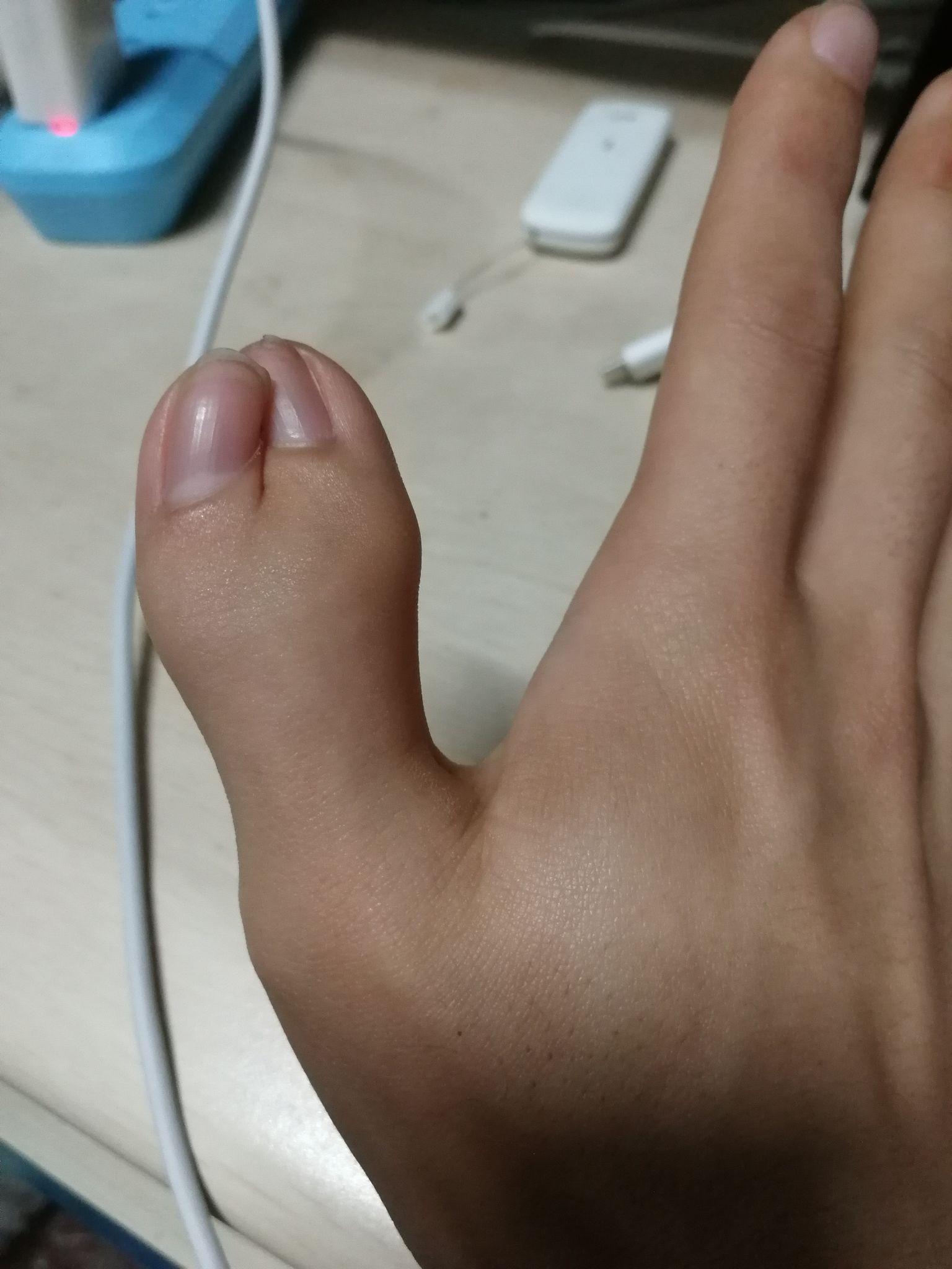 一只手有六个手指是种怎样的体验