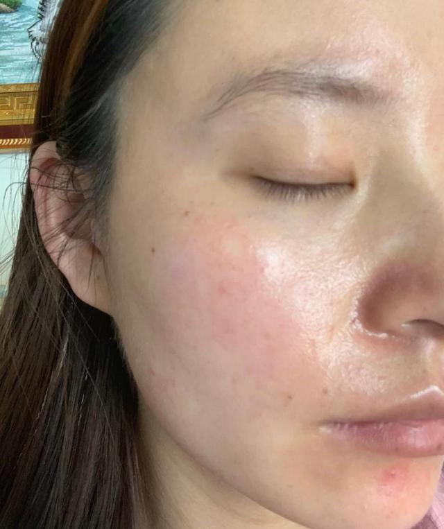 判断你是不是敏感肌看脸上这几个地方很简单就能看出来