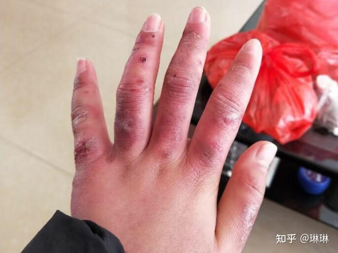 冻疮膏那款好用 - 知乎