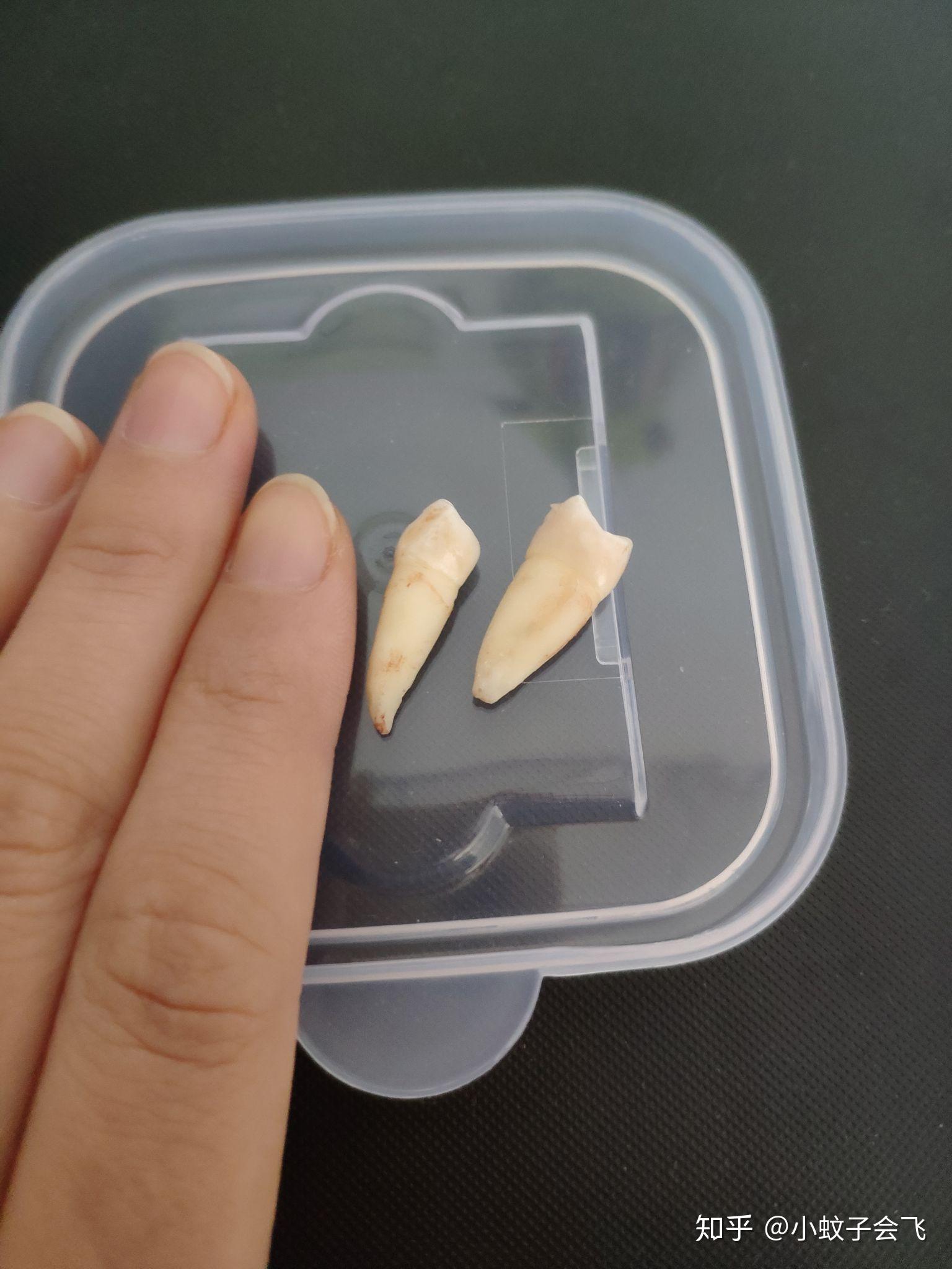 记录23岁矫正牙齿的漫漫长路矫正已结束