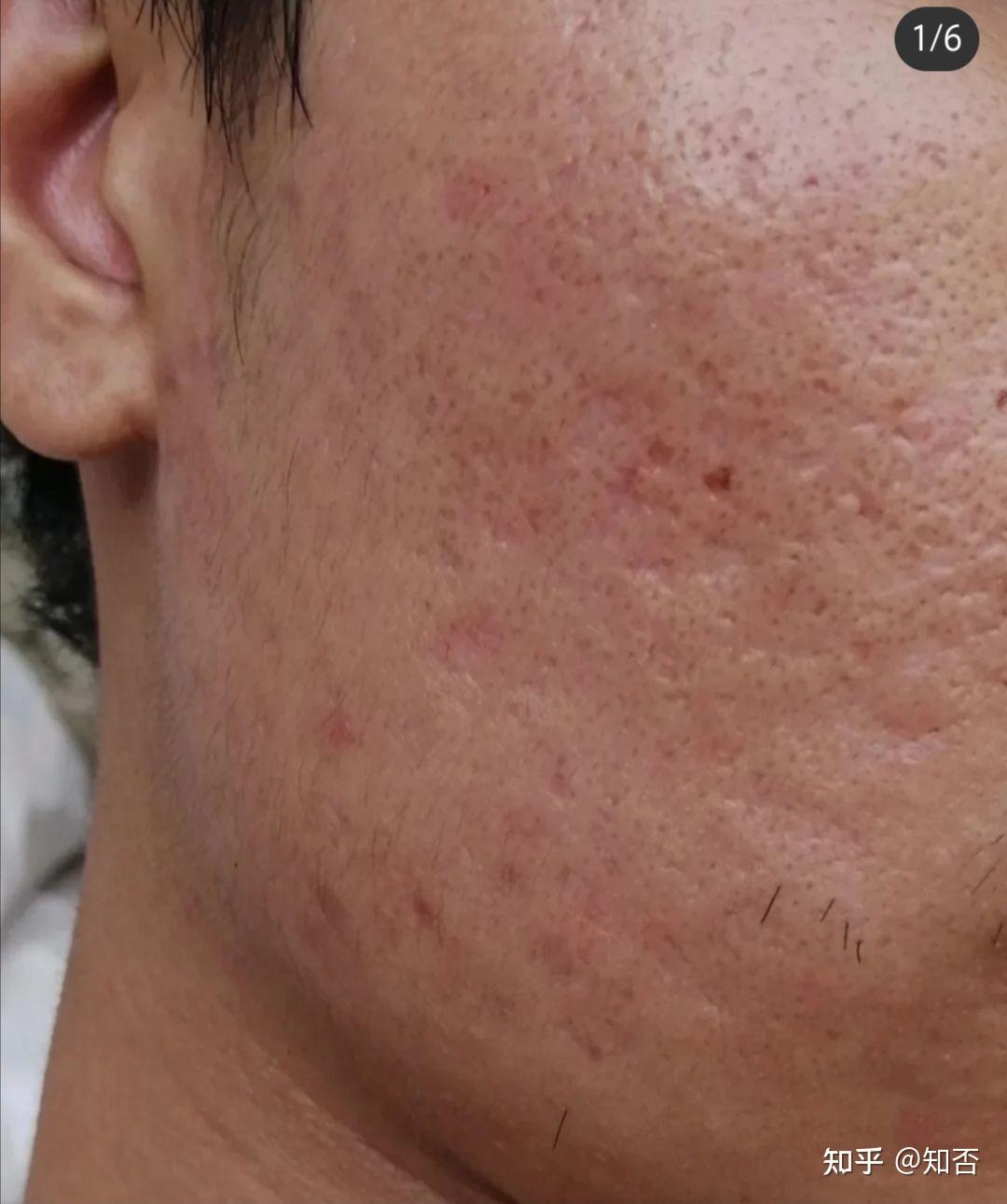 长痘六七年了,到现在留下一脸坑,有做过四次果酸换肤,还没做过医美,想