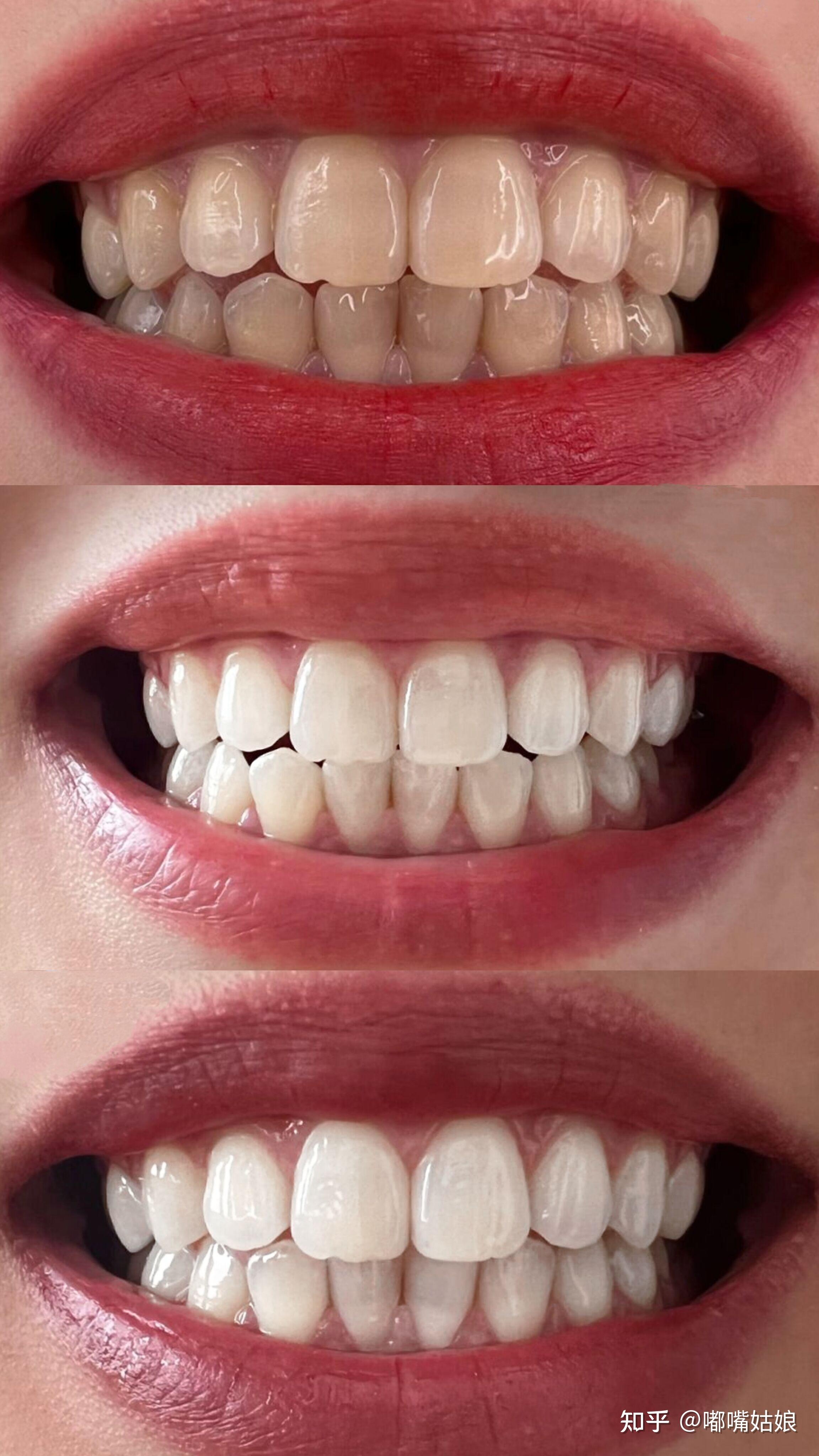 4,1天2毛钱刷出小白牙get自信笑容!