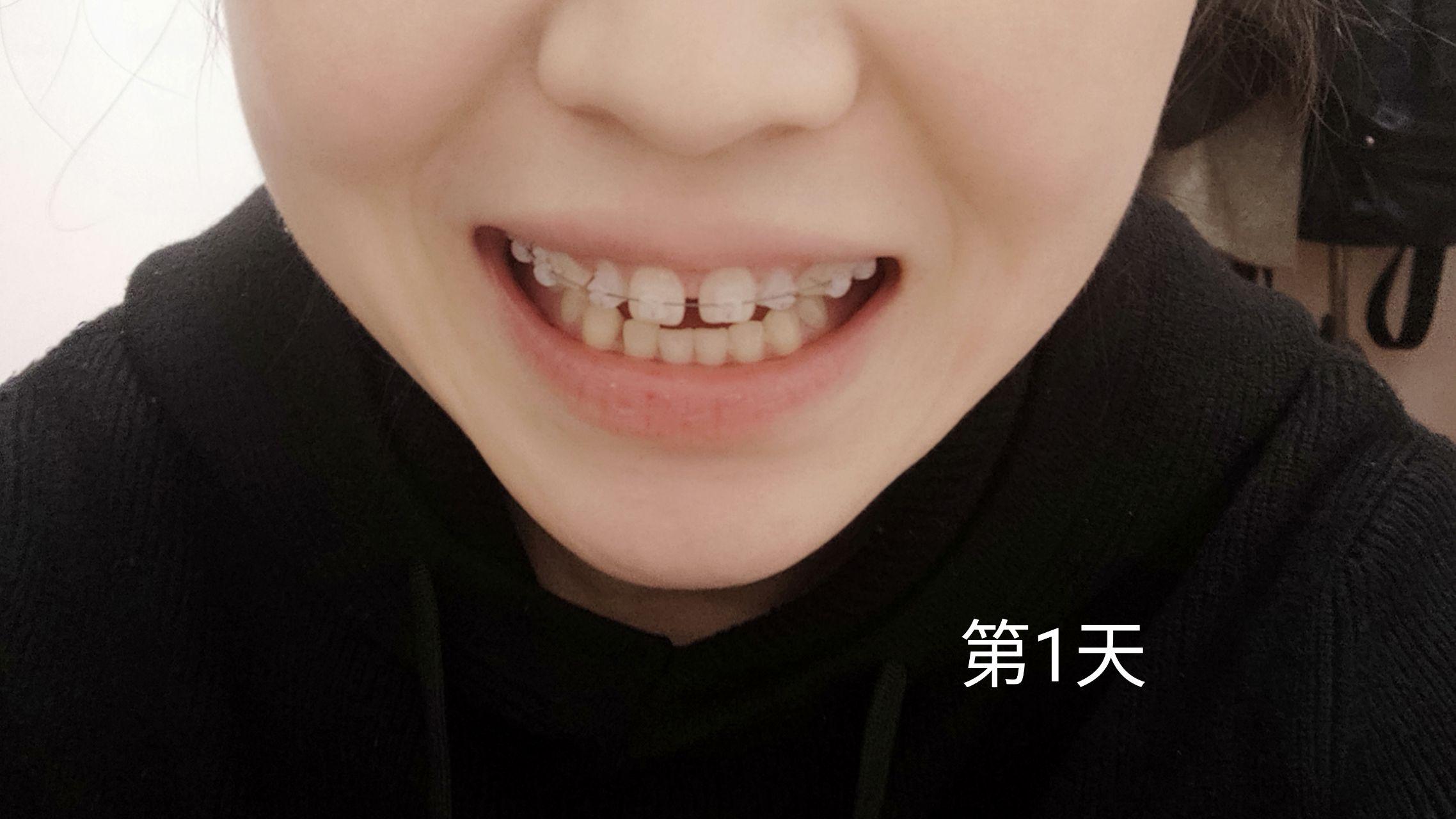 大龄正畸修复陶瓷自锁托槽牙缝和过小牙蜕变历程