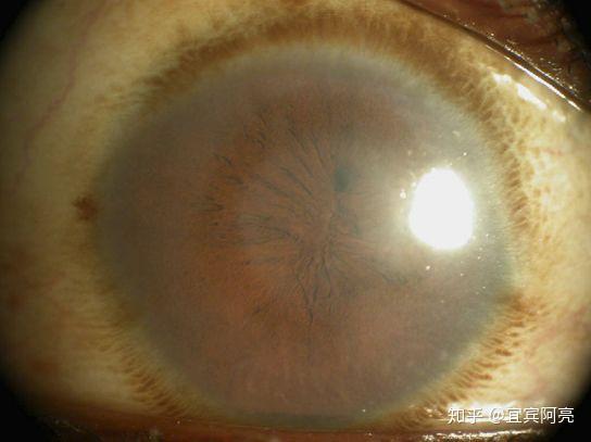 裂隙灯的检查流程和常见眼部问题总结