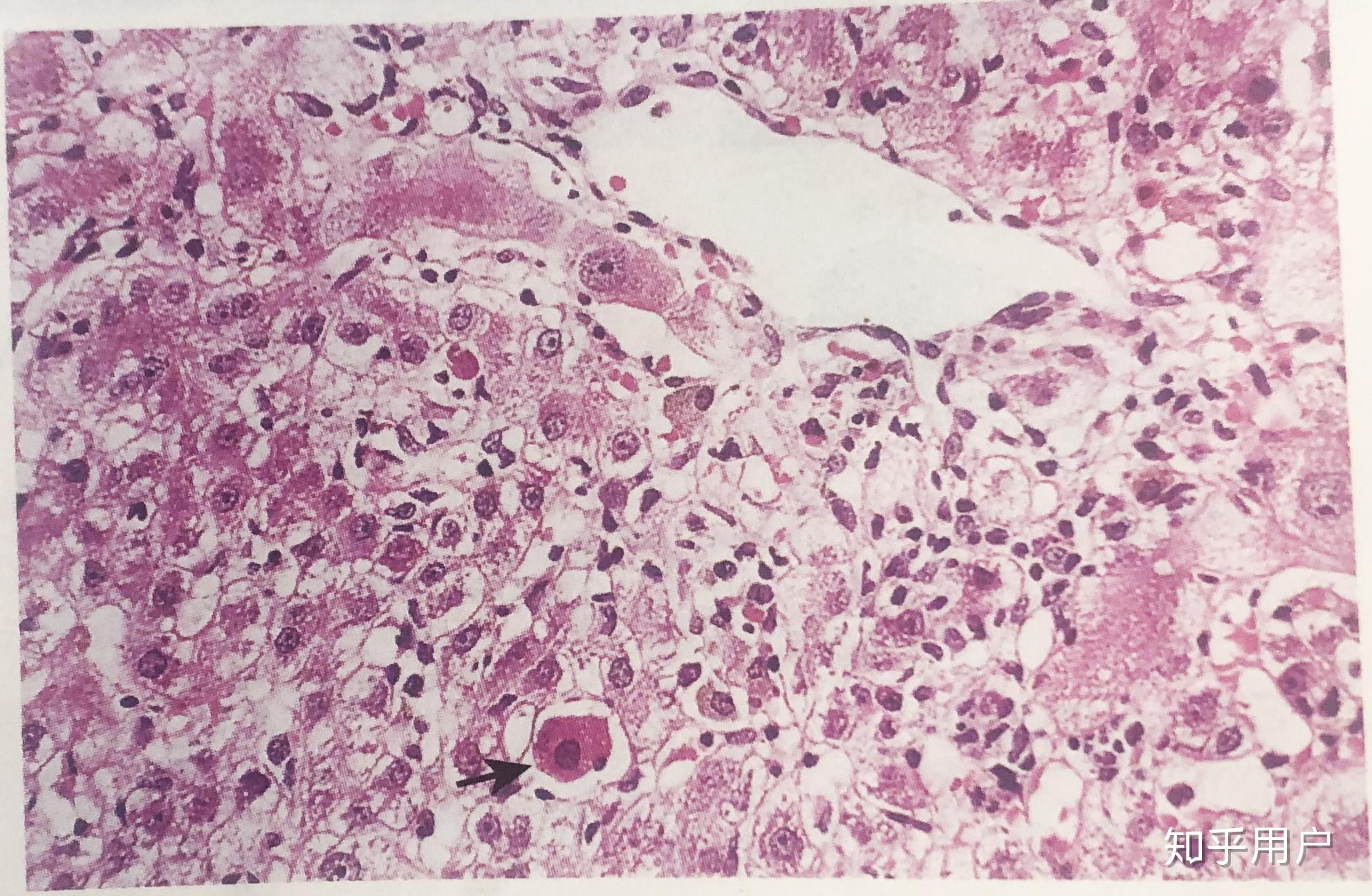 肝细胞水肿图图片