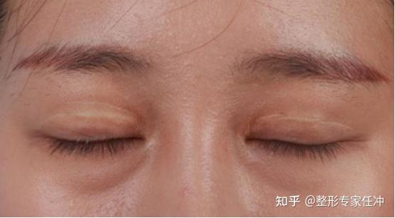 割双眼皮是微整小手术这9大双眼皮失败表现你有必要知道