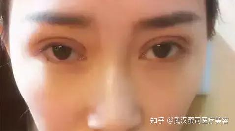 双眼皮手术平行的好看还是开扇形的好看 开眼角有必要吗 知乎 双眼皮手术平行的好看还是开扇形的好看 开眼角有必要吗 知乎