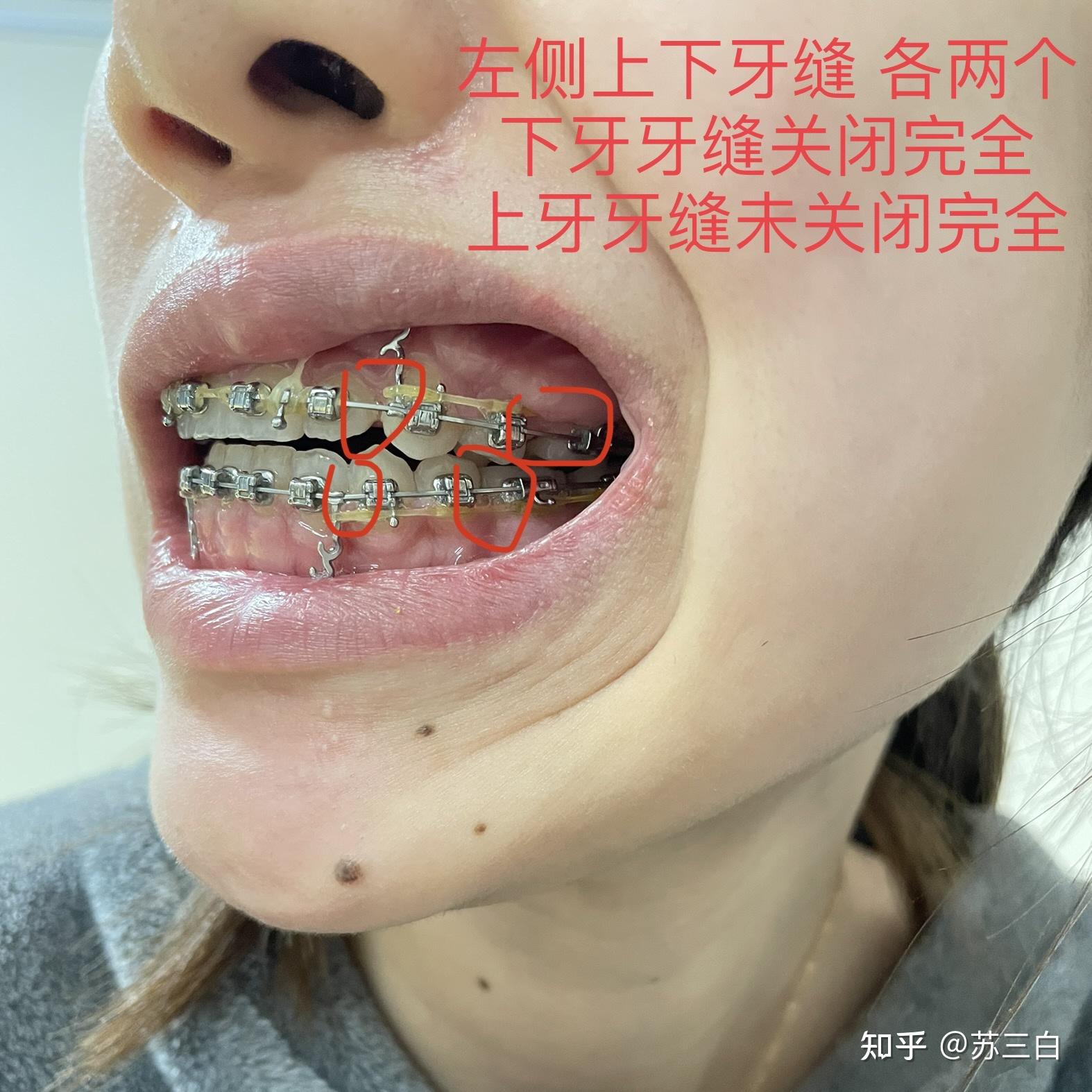 骨性嘴凸牙齒矯正上海口腔病防治院