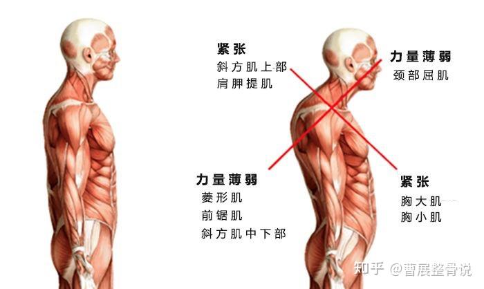 弱的肌肉:菱形肌 斜方肌中下束 前鋸肌骨骼結構變化頸椎生理曲度變直