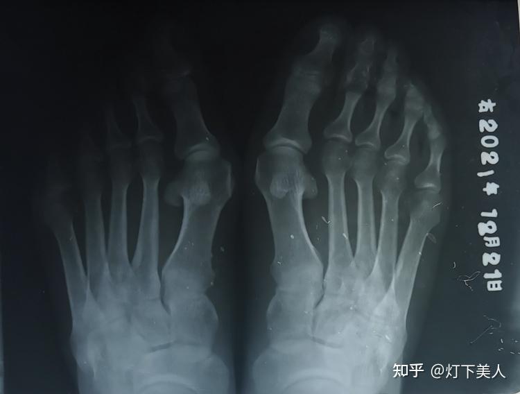 洛阳大脚骨磨人的大脚骨必须做手术吗