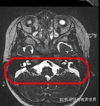 前庭导水管扩大\综合征的诊断与干预的再认识 - 知乎