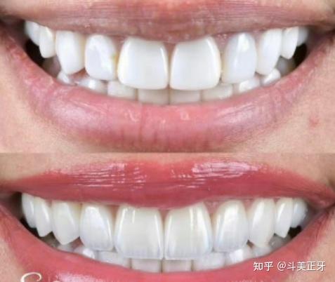 什么人适合做牙齿贴面?常见的牙贴面问题详细攻略文,一篇看懂!