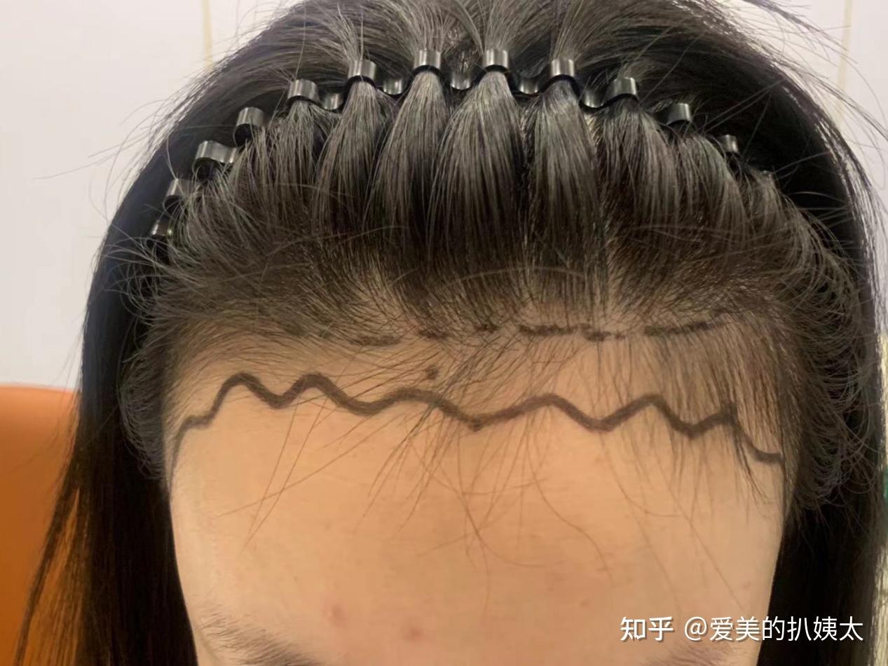 这些植发失败案例惨不忍睹! - 知乎