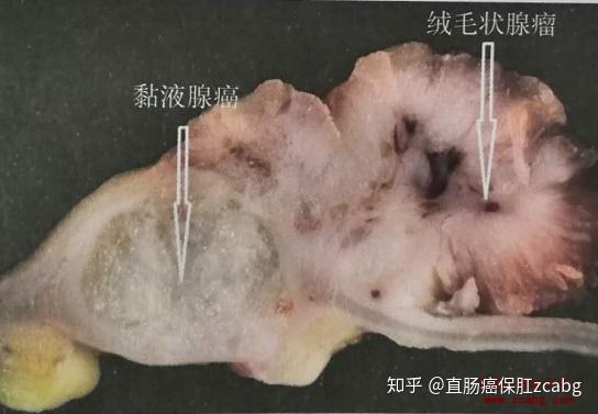 直肠绒毛状腺瘤局部发生癌变