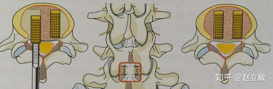 腰椎间盘突出椎骨融合术患者应该了解的知识