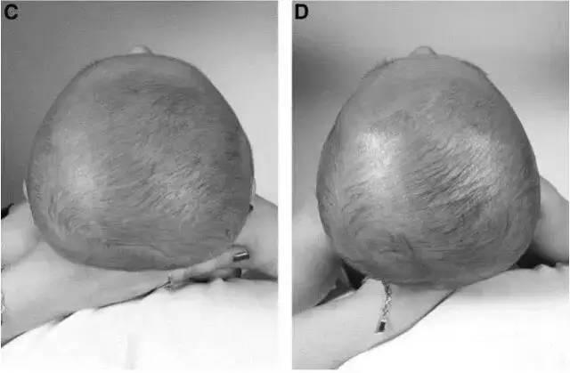烦恼|宝宝把头睡平了,还能再睡圆吗?