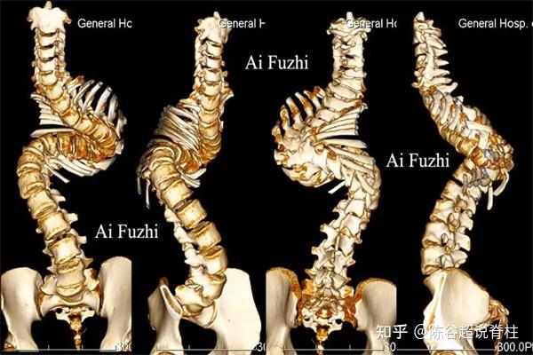 检查脊柱侧弯,应该拍摄全脊柱正侧位X光片还是核磁共振 - 知乎