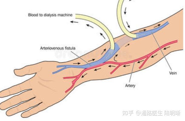 科普选择了血液透析为什么要提前做动静脉内瘘