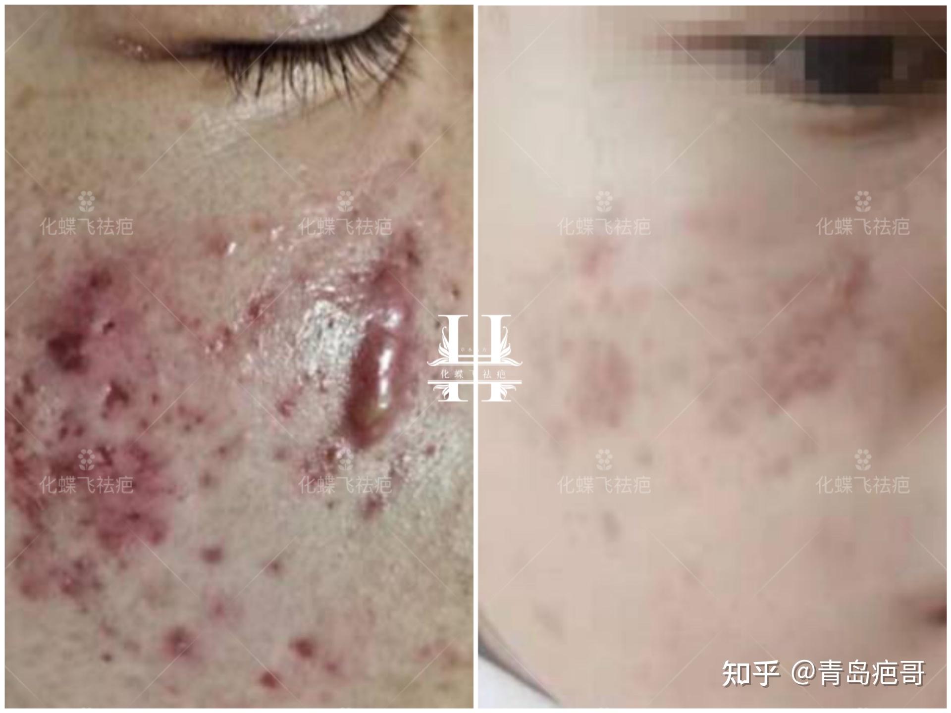 严重的痤疮增生疤痕 - 知乎