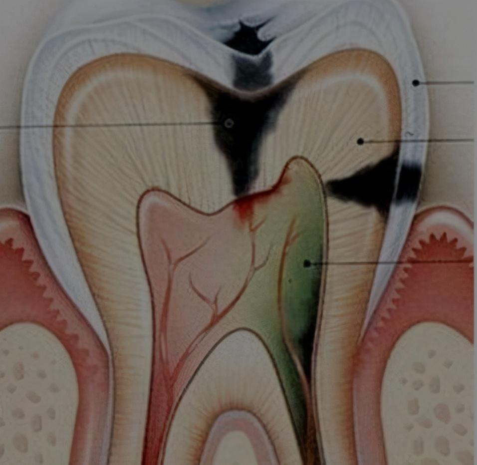 太阳穴等部位同时疼痛,使我们不能明确地指出到底是哪一颗牙牙齿坏了
