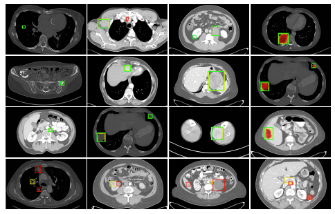 (实体肿瘤反应评估标准)标签的密集掩模的retinanet对ct病变的检测