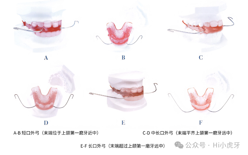 II类错颌畸形的